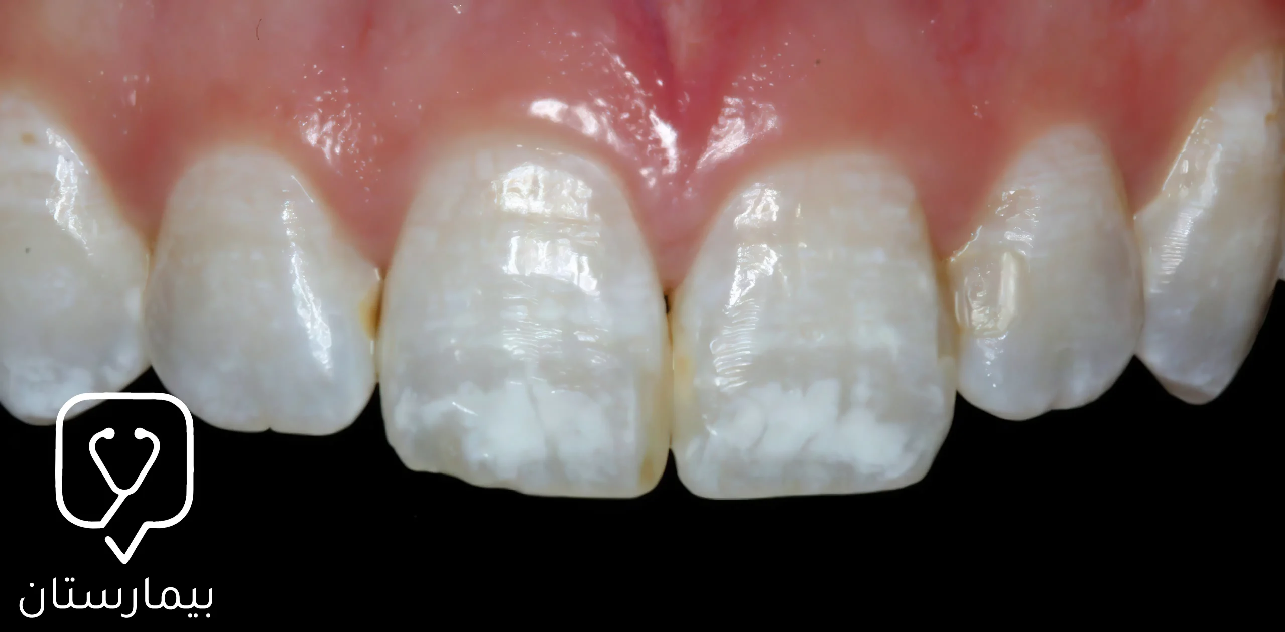 إن الإفراط في تناول الفلورايد واستخدامه الخاطئ قد يسبب الإصابة بتصبغات بيضاء تدعى بتسمم الأسنان الفلوري