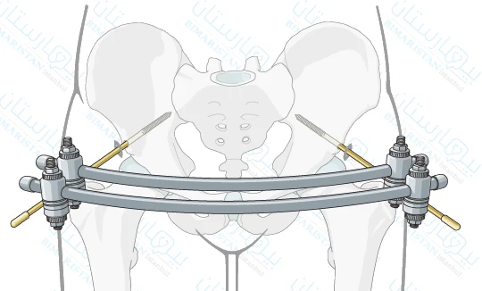 Image showing external fixation of the pelvis in the treatment of a pelvic fracture