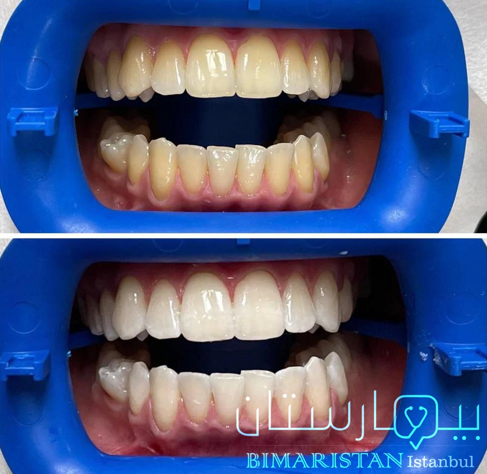 The end result is below after laser teeth whitening 