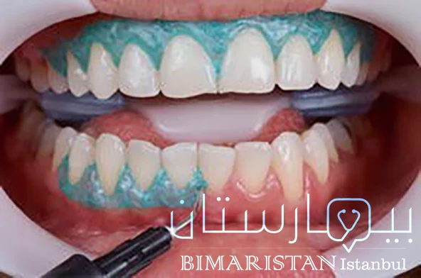 Isolate and protect the gums before starting laser whitening