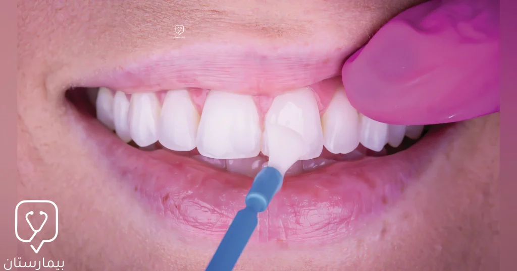Dişlere florürlü vernik uygulaması klinikte yapılır.