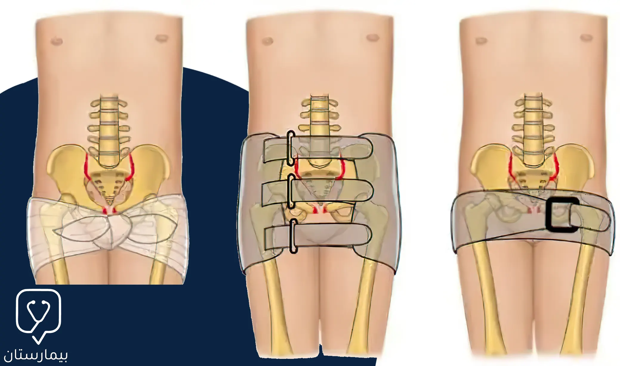 Image showing the pelvic ligament used in the initial management of a pelvic fracture and some of its variations