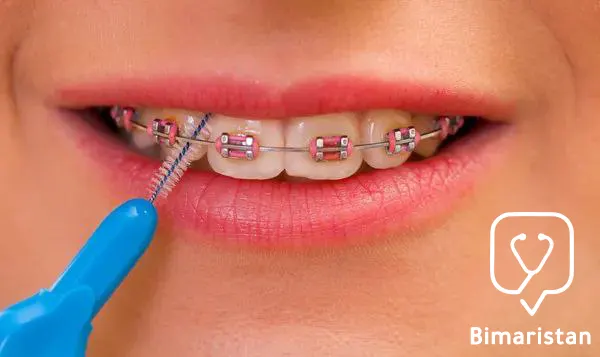 The orthodontic brush can pass freely under the wires and around the brackets to clean them