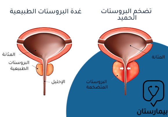 صورة تظهر مقارنة بين غدة البروستاتا الطبيعية في جسم الإنسان وحالة تضخم البروستات الحميد (BPH) والتي يمكن تدبيرها عبر علاج تضخم البروستات بالبخار