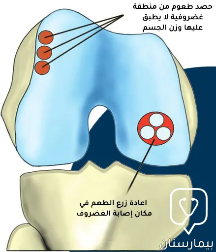 رسم يوضح عملية غضروف الركبة عن طريق استئصال طعوم ذاتية مأخوذة من جزء سليم من الغضروف وإعادة زرعها في مكان الإصابة