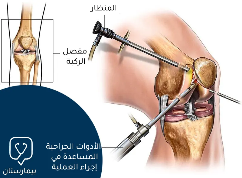 Image showing how to perform arthroscopic knee cartilage surgery