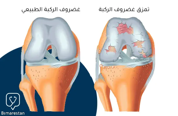 توضح هذه الصورة مقارنة بين الغضروف الطبيعي للركبة وغضروف متمزق يحتاج لإجراء عملية غضروف الركبة لإصلاحه