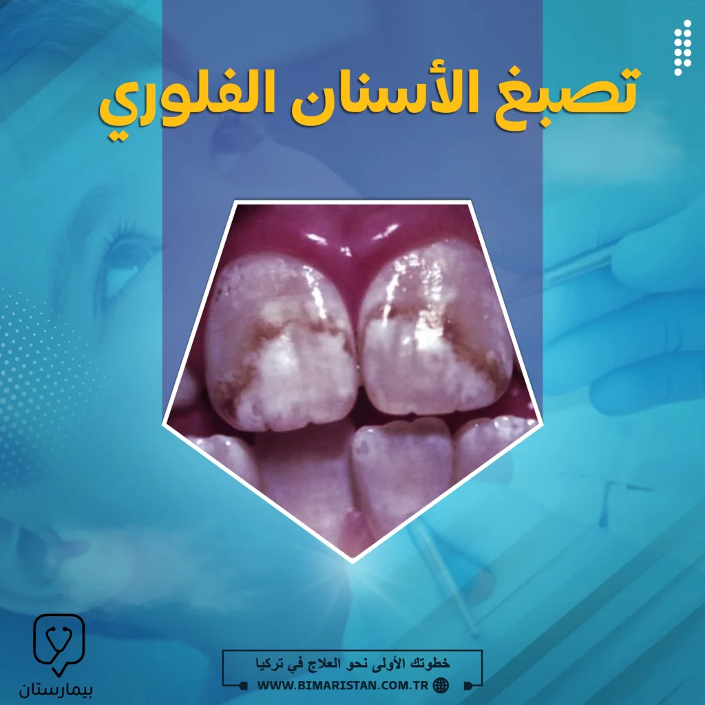 Fluorosis of the front teeth