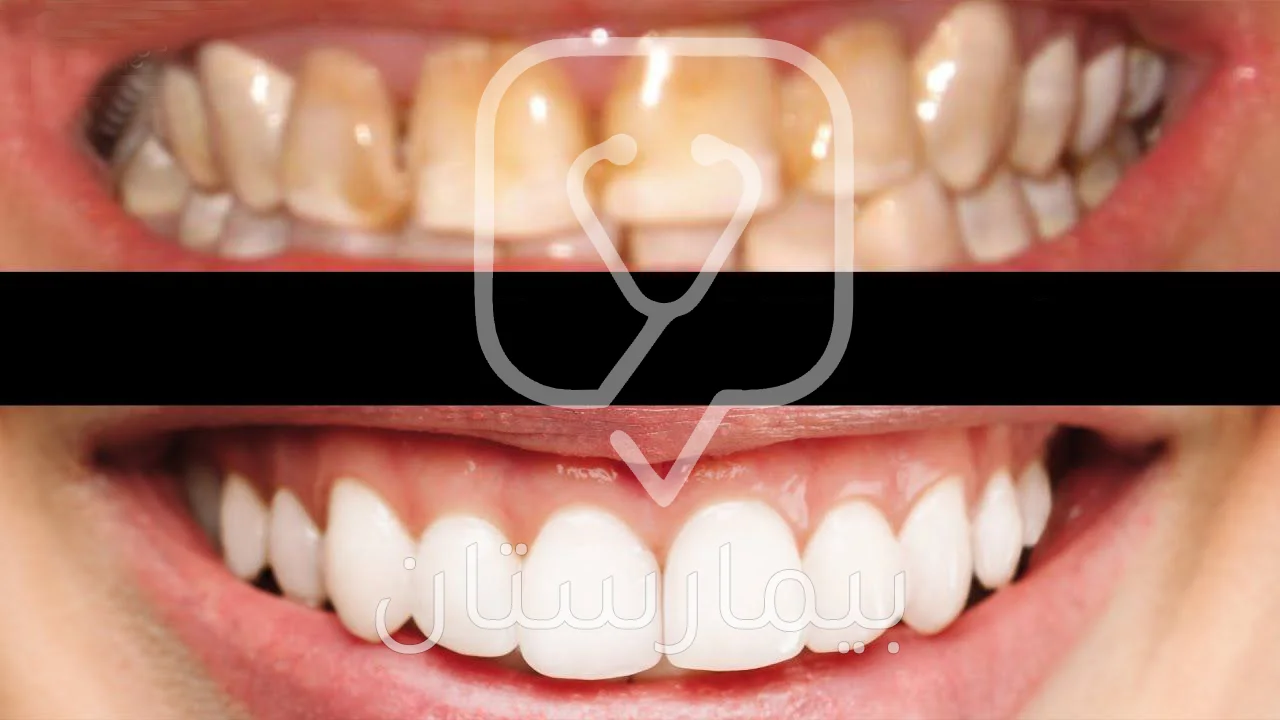 Şiddetli flüoresan diş pigmentasyonunun pigmentasyon bölgelerini diş kronları ile kaplayarak tedavisi