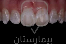 نرى على الأسنان بقع بيضاء غير واضحة بسبب وجود تصبغ أسنان فلوري خفيف وهو لا يحتاج لعلاج