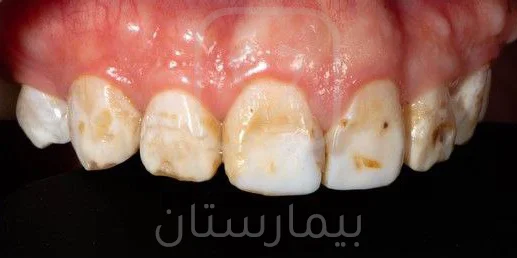 Medium-intensity fluorescent pigmentation that affects the aesthetic aspect of the teeth