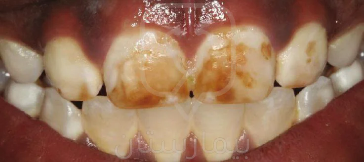 Severe dental fluorescent pigmentation on the front teeth