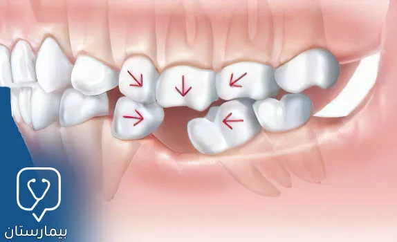 تمنع حافظة المسافة للأسنان تحرك الأسنان باتجاه الفراغ مكان السن المخلوع