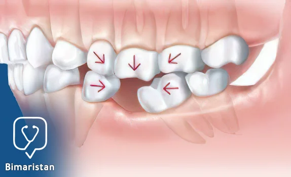 The spacer retainer prevents the movement of the teeth toward the space where the extracted tooth is located