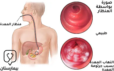 Gastroscopy image showing gastritis caused by Helicobacter pylori