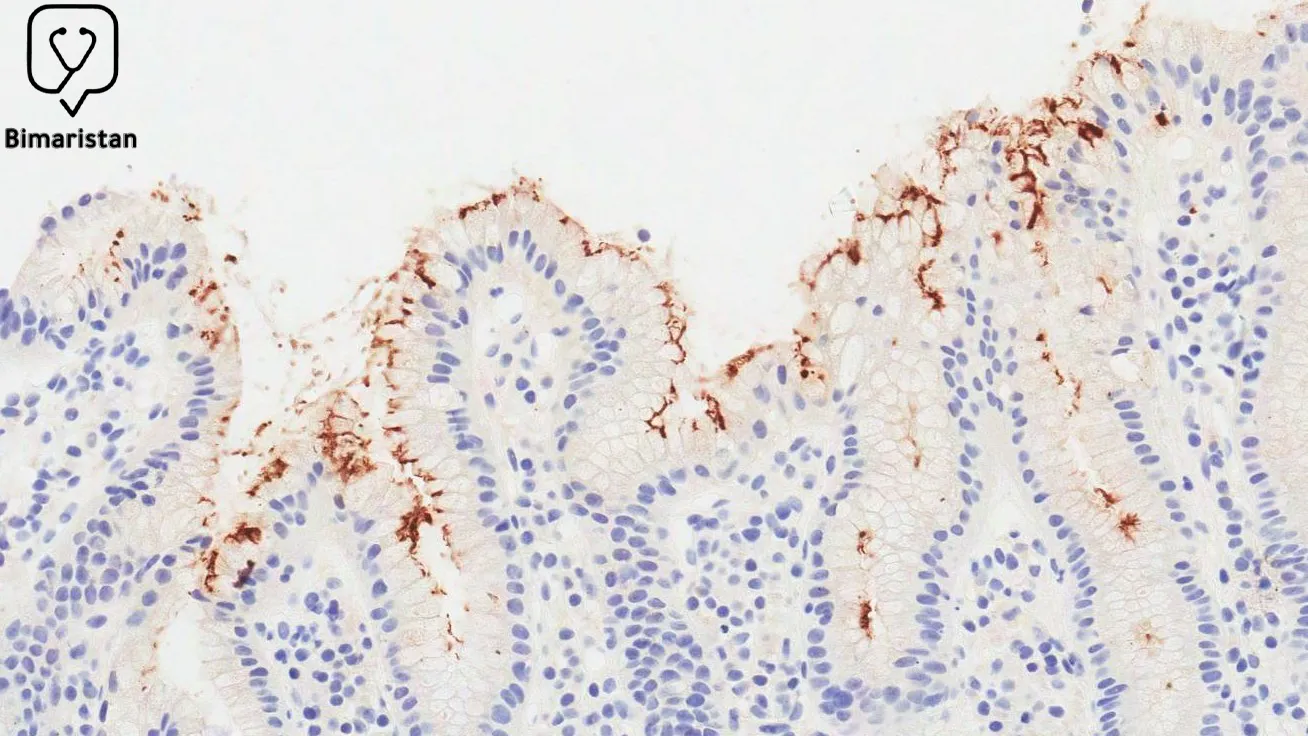 A picture showing the stomach germ in a biopsy stained with a special color