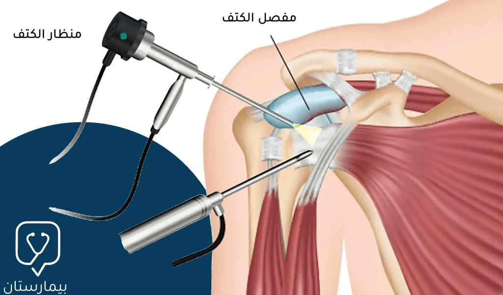How to perform arthroscopic shoulder dislocation surgery