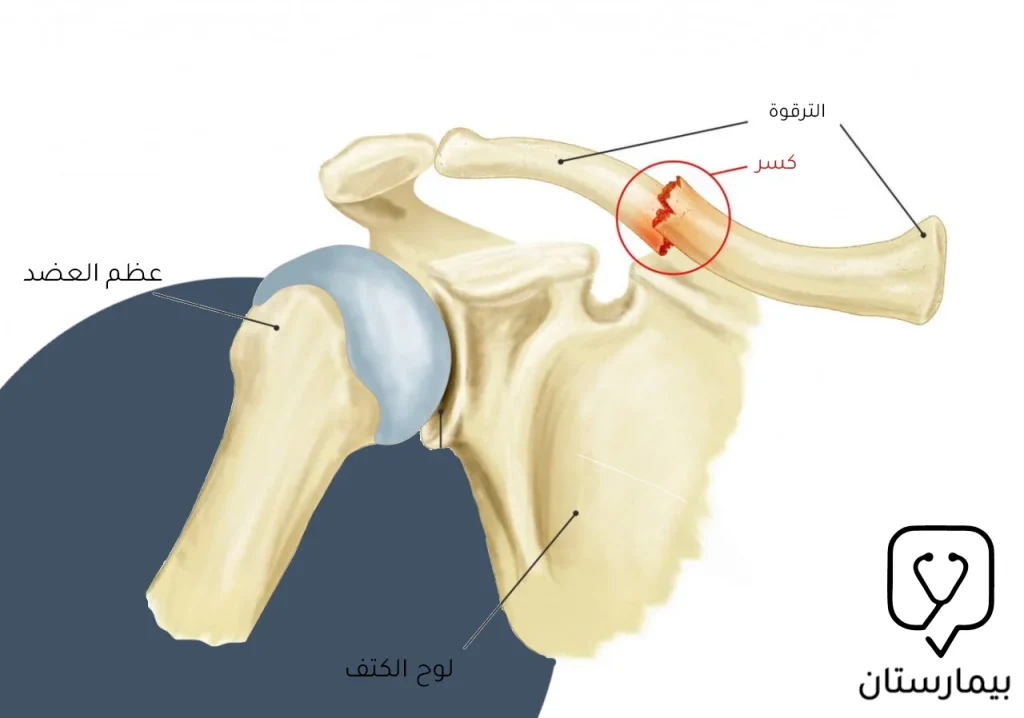 A picture of a broken collarbone, which is the most common type of shoulder fracture