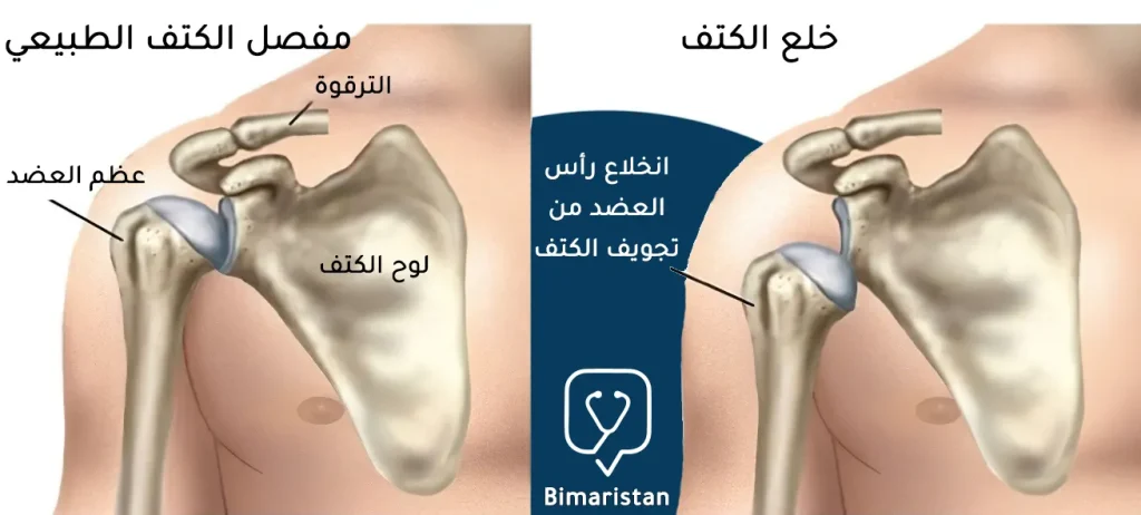 This image compares a typical shoulder joint and a dislocated shoulder.