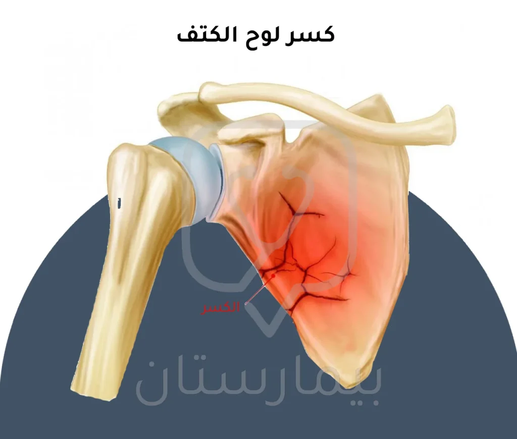 Illustrative image of a rare type of shoulder fracture, which is a scapula fracture 