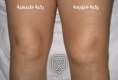 نلاحظ في هذه الصورة مقارنة بين حالة تورم مفصل الركبة والركبة الطبيعية