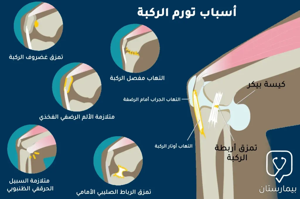 أسباب تورم الركبة كالتهاب المفاصل والأوتار أو تمزق الأربطة وغيرها من المسببات الأخرى 