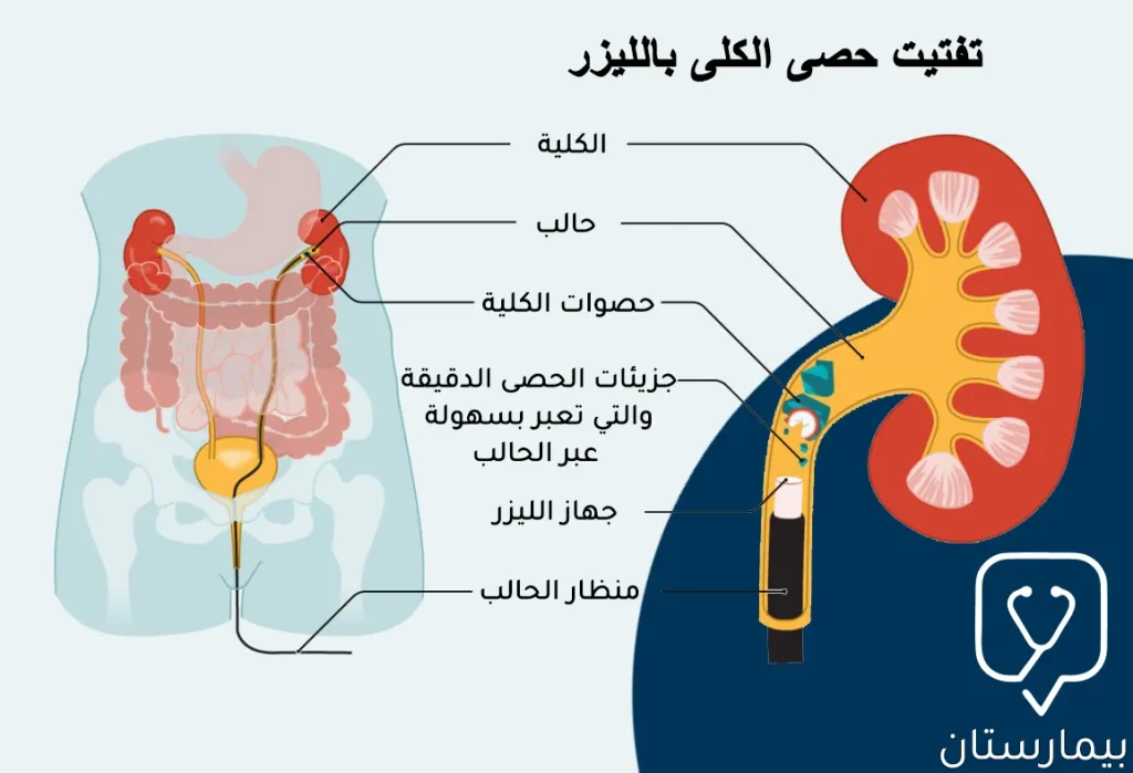 This picture shows the steps of the laser lithotripsy procedure, which is done by using a ureteroscope