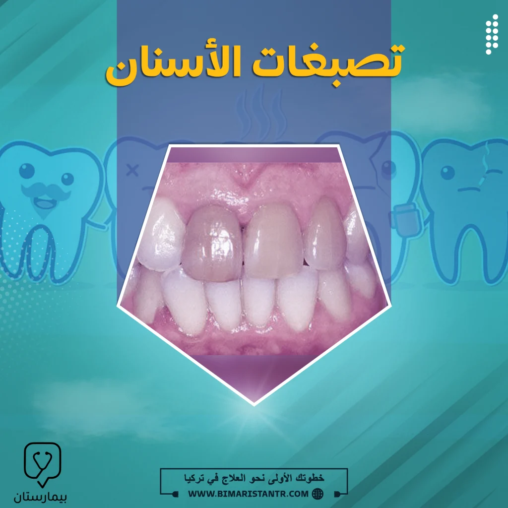 Types, causes and treatment of tooth pigmentation