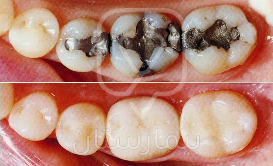 The second picture is after removing the silver amalgam fillings and replacing them with cosmetic composite fillings that are the color of the natural tooth.