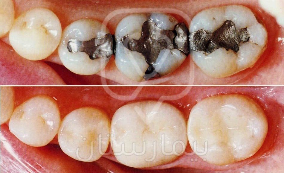 الصورة الثانية بعد إزالة حشوات الأملغم الفضية واستبدالها بحشوات الكومبوزيت التجميلية التي تكون بلون السن الطبيعي