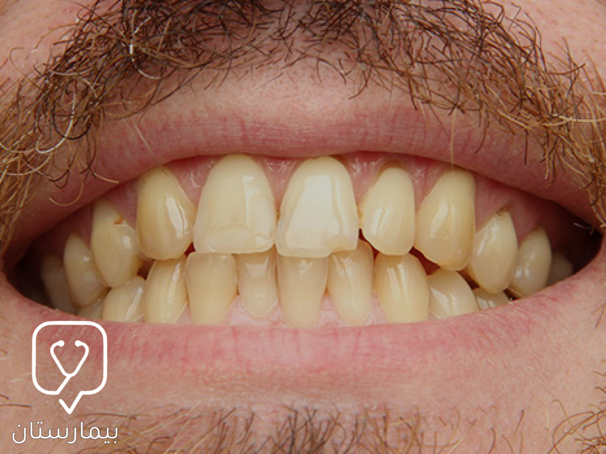 Yellowing of the teeth may occur as a result of aging or eating sugary and colorful foods