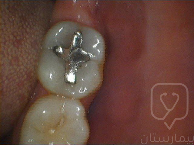 Silver dental amalgam fillings may cause discoloration of the tooth and adjacent gums.