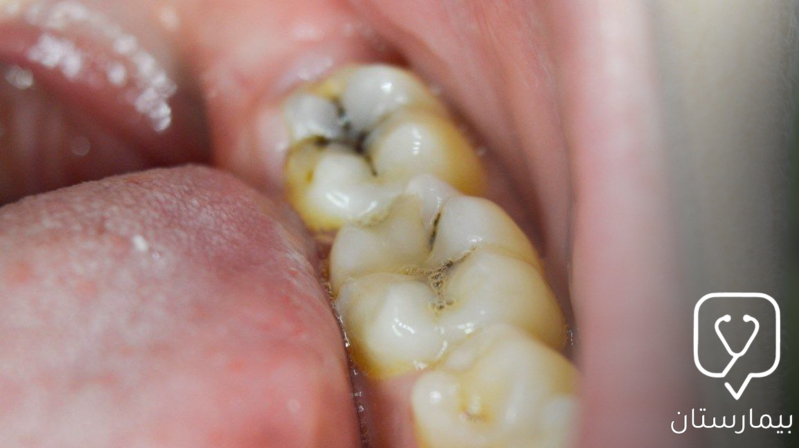 Black pigmentation of the teeth here indicates the presence of caries.