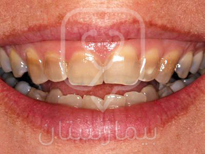 Tooth discoloration due to childhood fluoride overdose