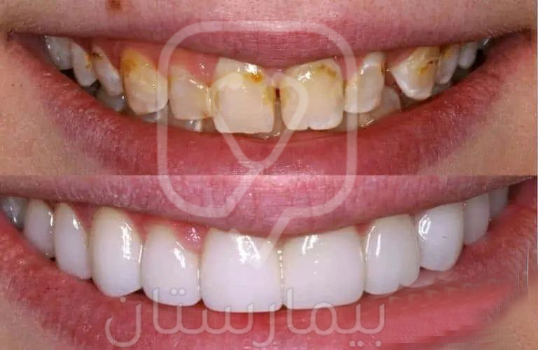 الأسنان في الصورة الأولى تعد استطباب مثالي لقشور الفينير التجميلية ونرى في الصورة الثانية كيف أخفت هذه القشور العيوب الشكلية واللونية للأسنان بشكل مثالي