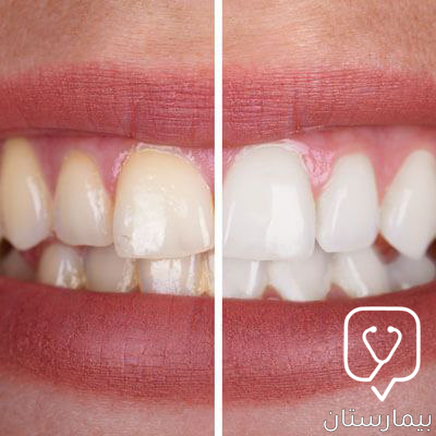 على اليسار تظهر الاسنان صفراء وعلى اليمين نرى كيف أصبحت بيضاء طبيعية بواسطة مواد تبييض الاسنان