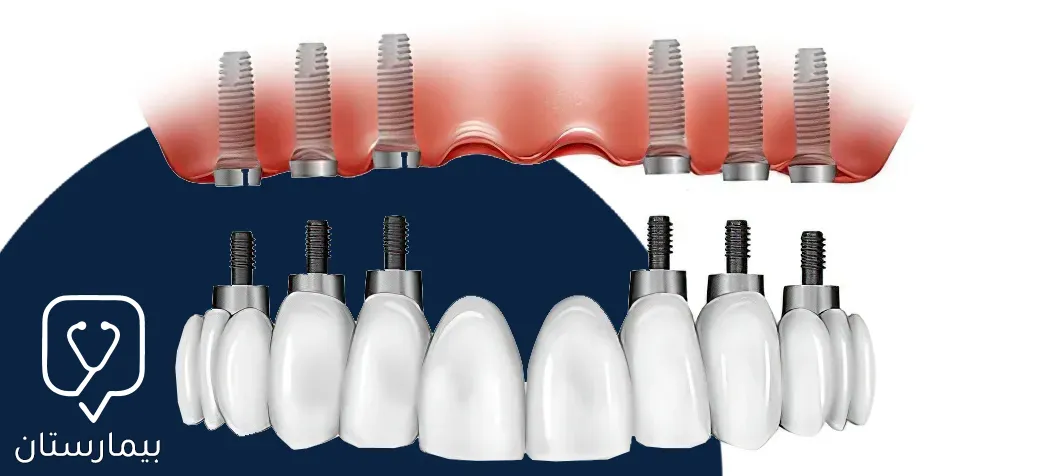 Resimde diş implantlarının all on 6 teknolojisi kullanılarak yerleştirildiğini ve üzerlerine sabit köprü yerleştirildiğini görüyoruz.