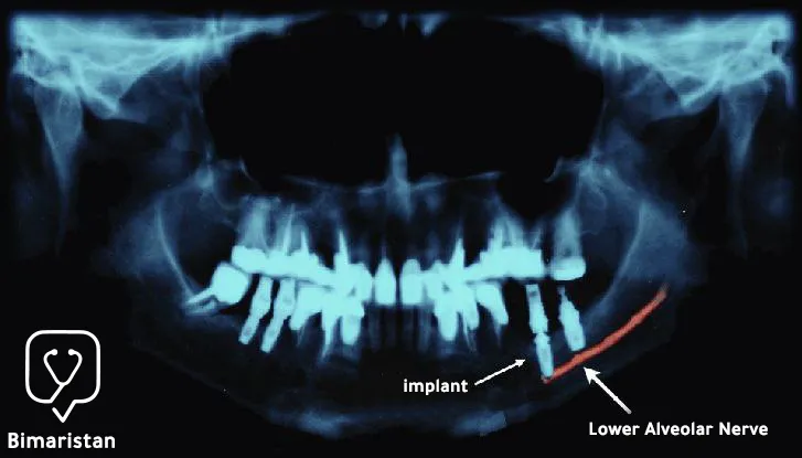 We notice in the picture the close proximity of the implant to the inferior alveolar nerve, which causes damage to the nerve