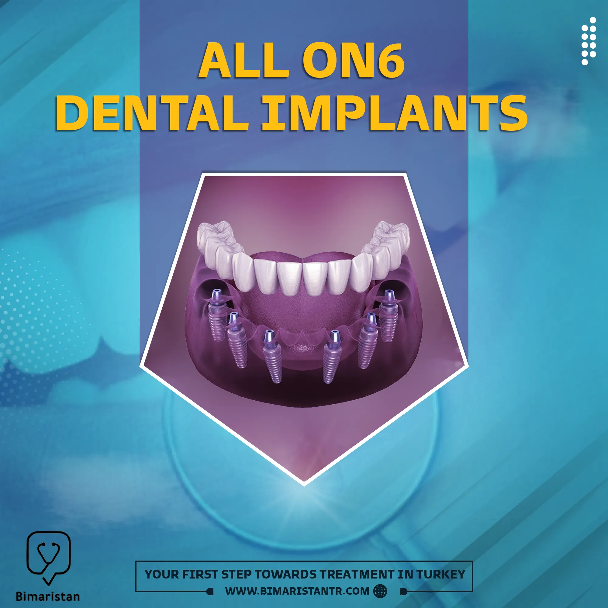 Dental Implants with All-on-6 Technique