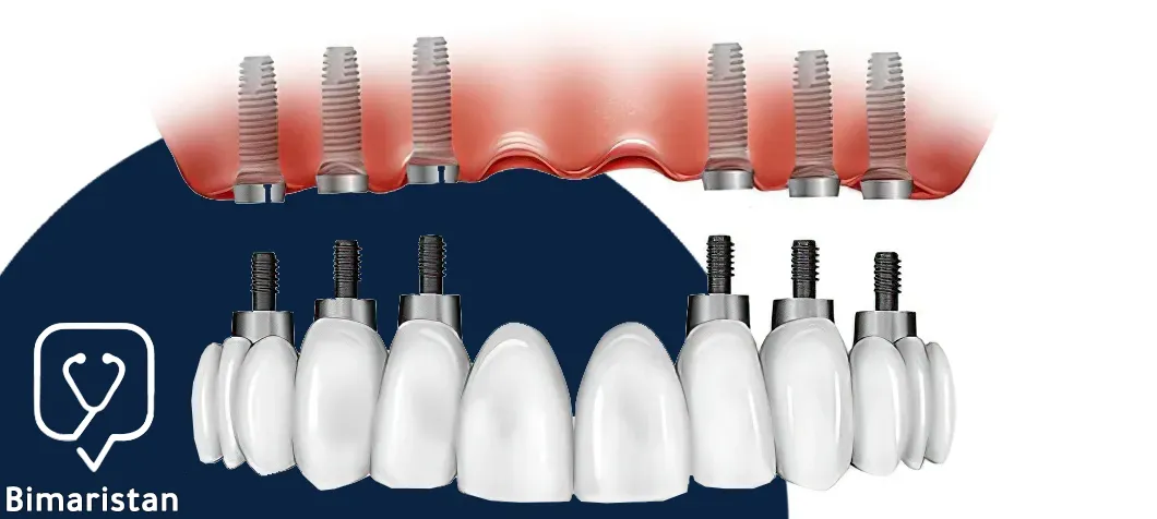 We notice in the picture that the dental implants are placed using the all on 6 technology, and the fixed bridge is placed over them