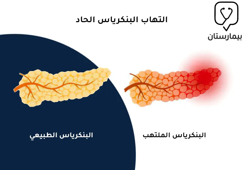 صورة توضح حالة التهاب البنكرياس الحاد بالمقارنة مع البنكرياس الطبيعي