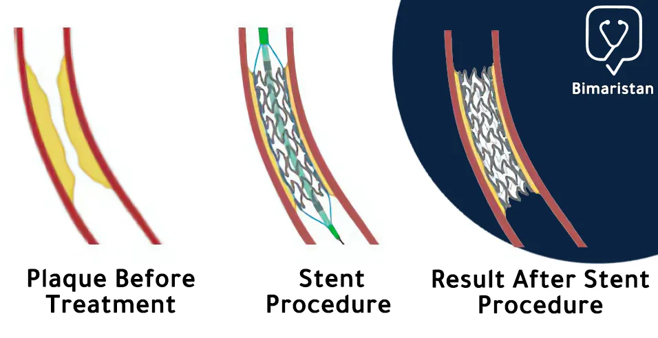 The shape of a heart stent that has been fitted to widen a narrowed artery