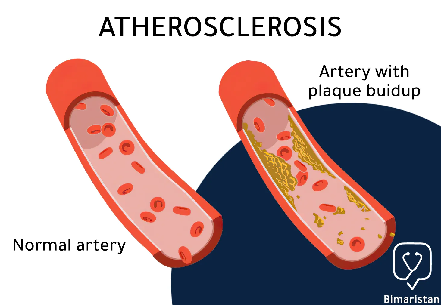 This picture shows the case of atherosclerosis, which manifests as a narrowing of the artery due to the accumulation of fatty plaques around the vessel wall, which requires the installation of a stent to widen the artery.
