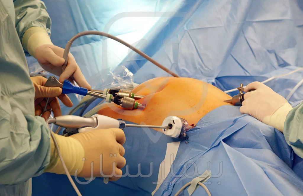 Image showing how laparoscopic varicocele surgery is performed 