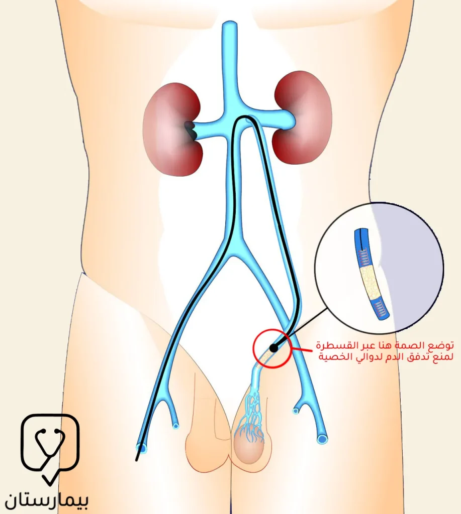 Bu resim damarları tasarlayan kateter ile varikosel ameliyatının nasıl yapıldığını göstermektedir.