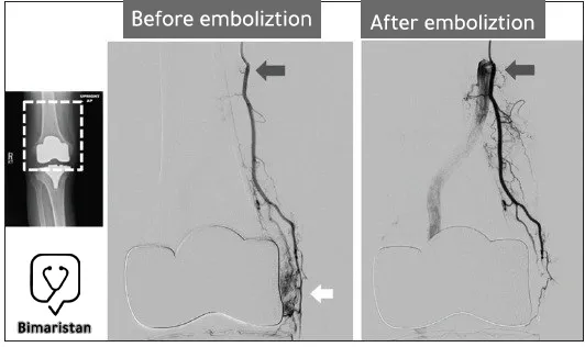 Angiography showing the knee arteries before and after embolization