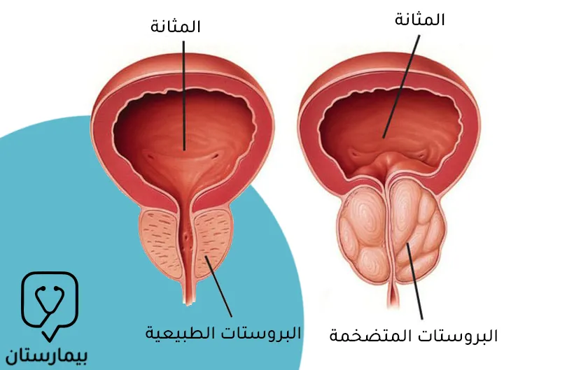 İyi huylu prostat hiperplazisi ile normal bir prostatı karşılaştıran görüntü