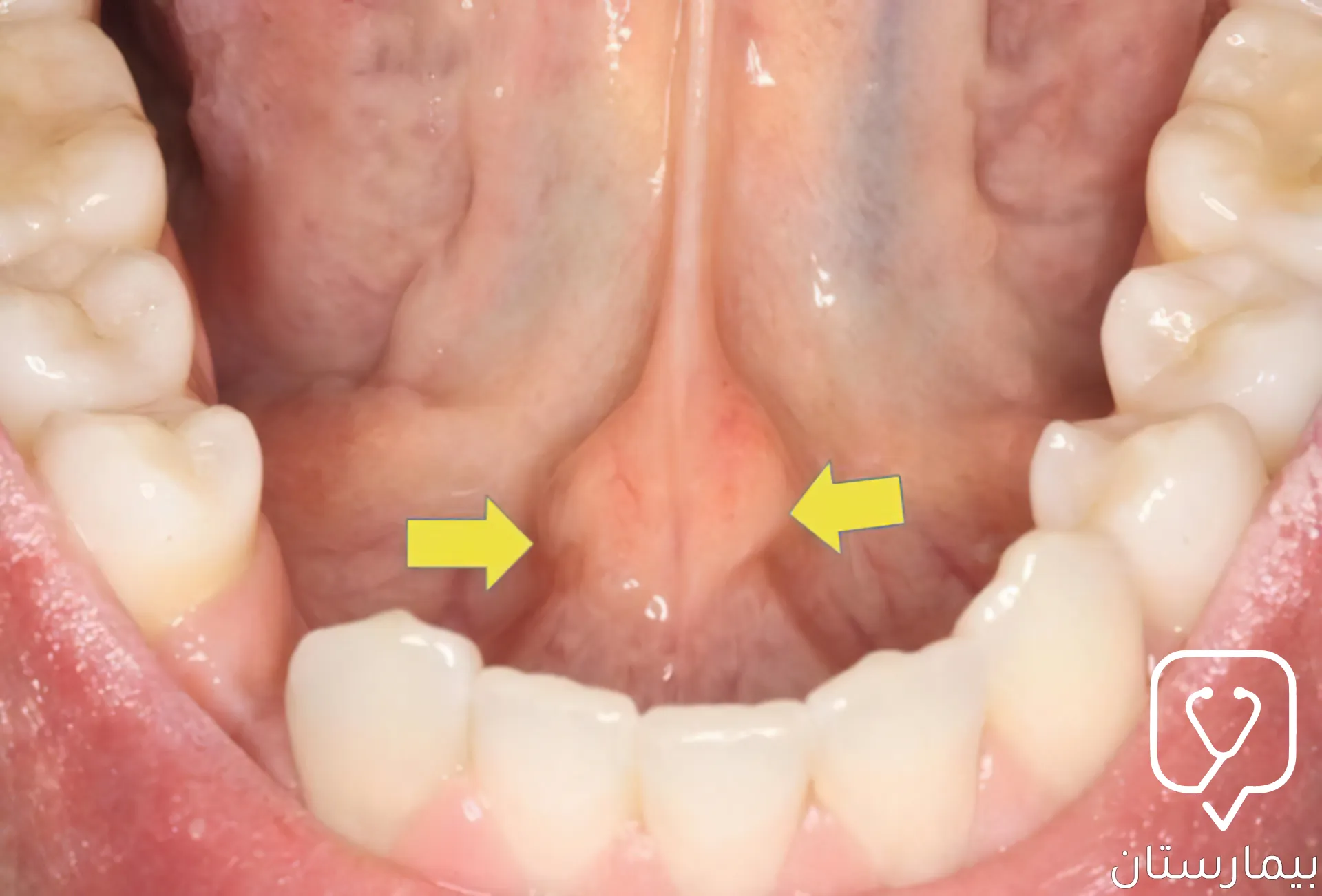 يدل الإنتفاخ الذي يشير إليه السهم على وجود حصوة في أرضية الفم