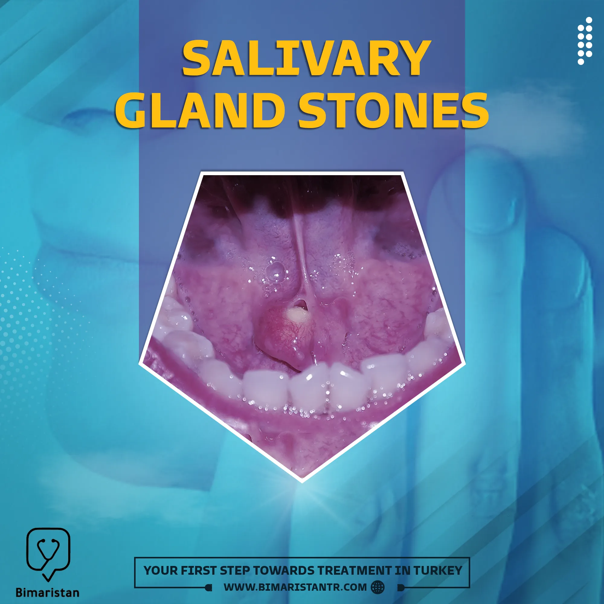 Causes, symptoms, and treatment of salivary gland stones