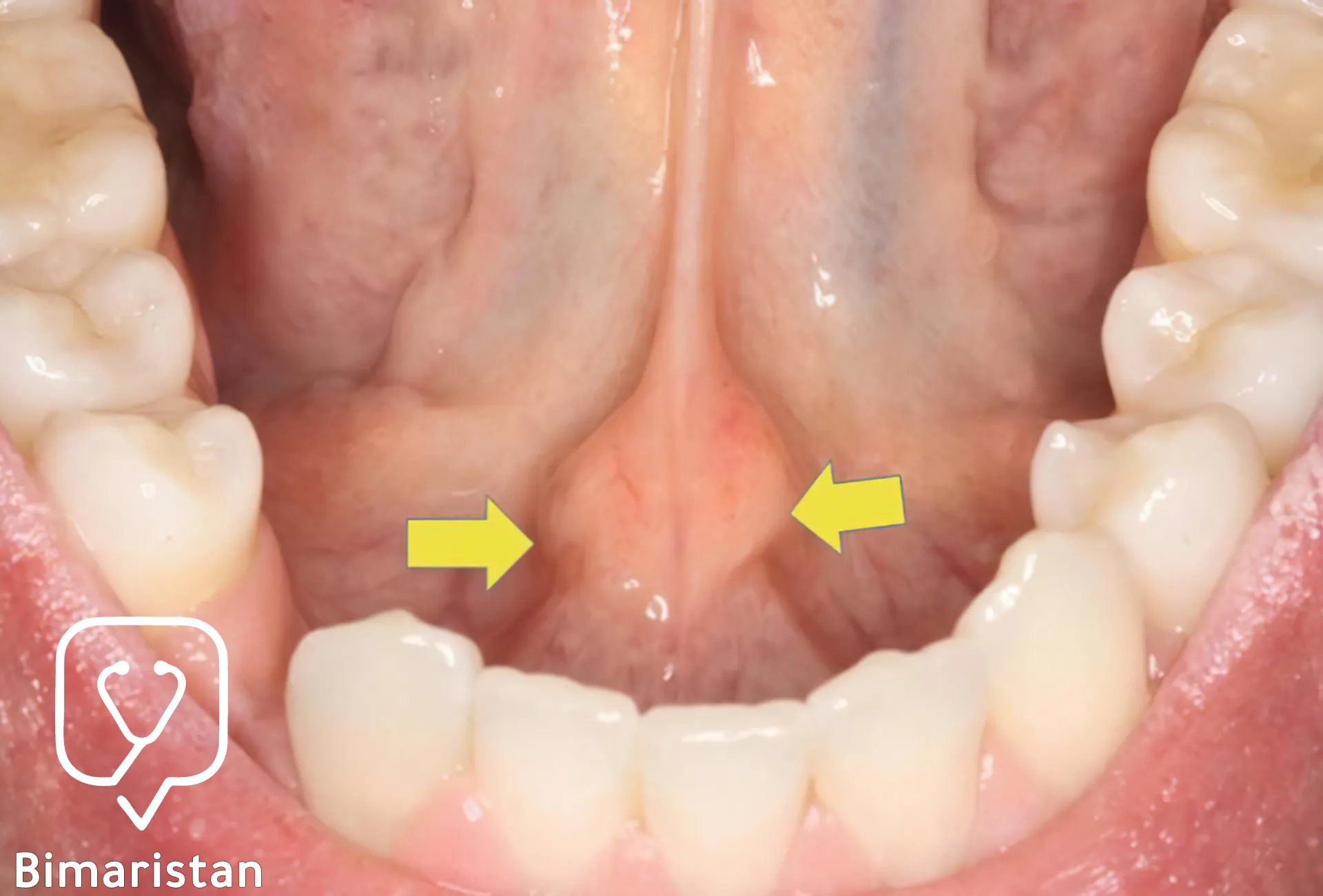 The swelling indicated by the arrow indicates the presence of a stone in the floor of the mouth